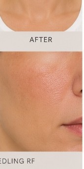 After Microneedling