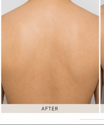 After Body Peel (Back & Chest)