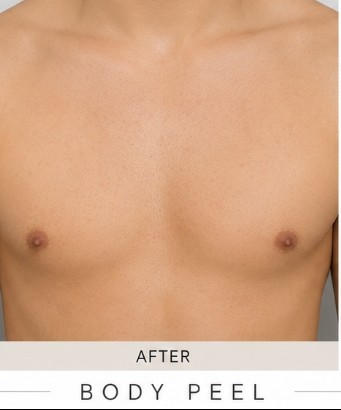 After Body Peel (Back & Chest)