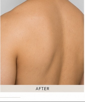 After Body Peel (Back & Chest)