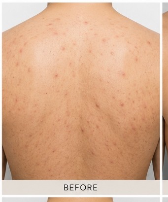 Before Body Peel (Back & Chest)