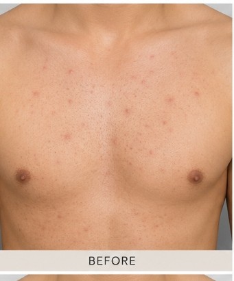 Before Body Peel (Back & Chest)
