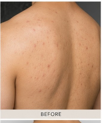 Before Body Peel (Back & Chest)