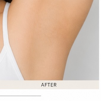 After Exciplex Alopecia Treatment