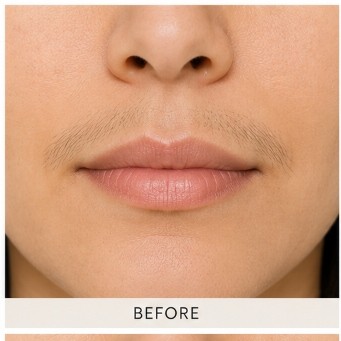 Before Exciplex Alopecia Treatment
